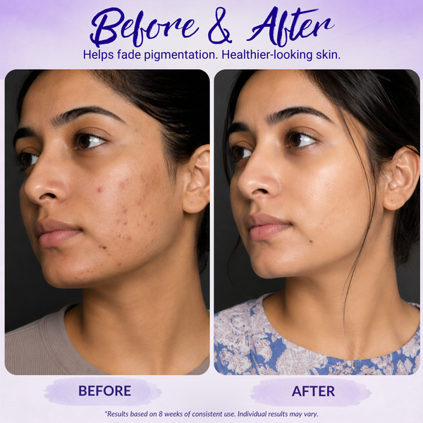 Yafé Azelaic Acid Face Serum for Dark Spots, Acne Marks & Uneven Skin Tone, 30ml
